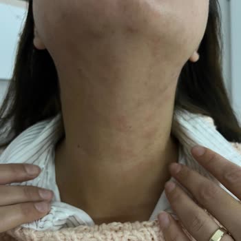 Hediye Ürün Alerjik Reaksiyona Sebep Oldu