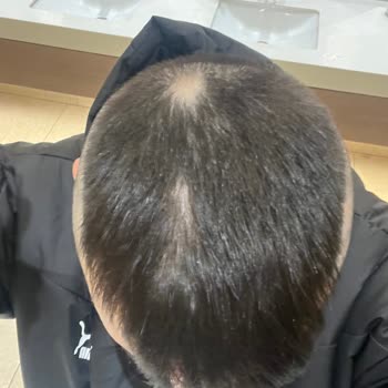 Bioxcin Ürünü Saç Dökülmesi Sorunu Yaşatıyor!