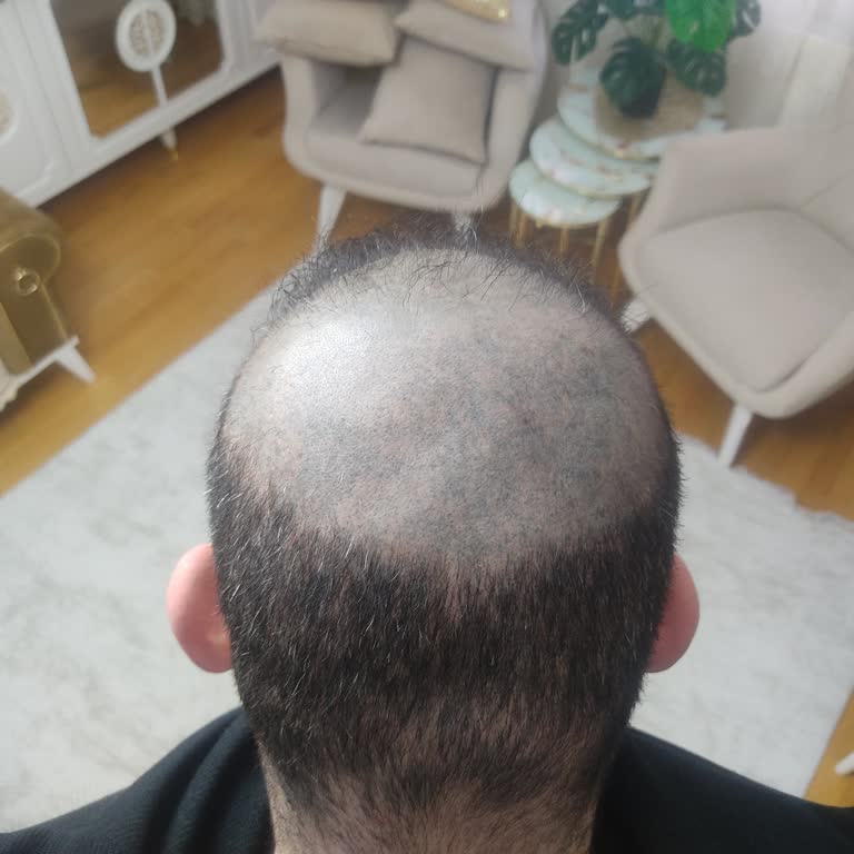 Dövme Renk Değişimi Ve Müşteri Memnuniyetsizliği