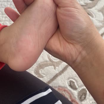 Bebeğimde Evolvia Mama Sonrası Cilt Reaksiyonu