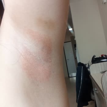 Agiss Tüy Dökücü Sprey Yanıkları Ve Etkisizliği