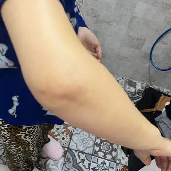 Başkent Hastanesi'nde Damar Yolu Sorunu Ve İlgisizlik