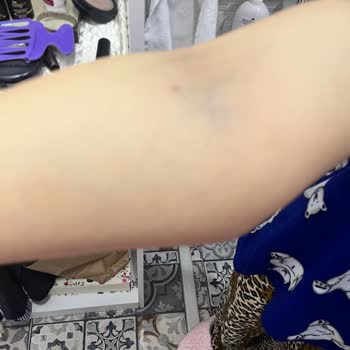 Başkent Hastanesi'nde Damar Yolu Sorunu Ve İlgisizlik