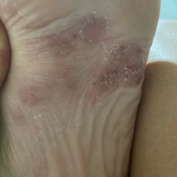 Купленные туфли Birkenstock вызвали раны на ногах