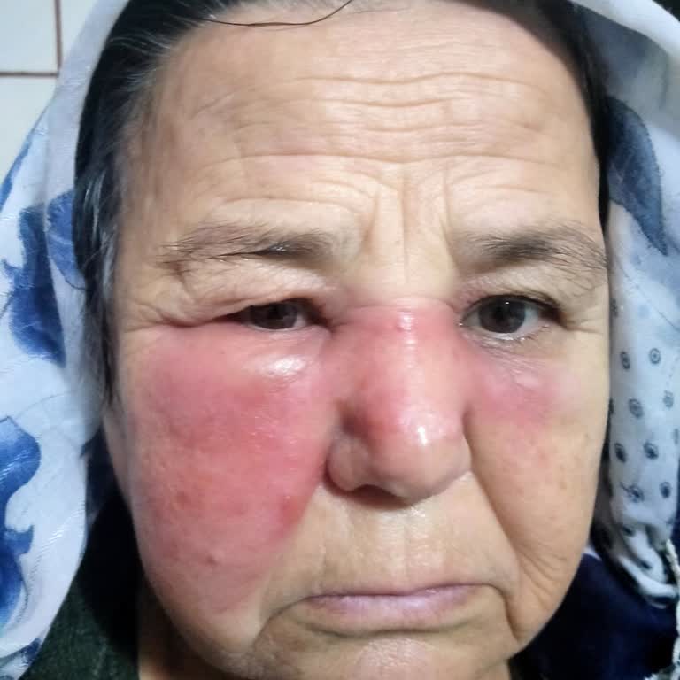 Cips Tüketimi Sonrası Ciddi Alerjik Reaksiyonlar