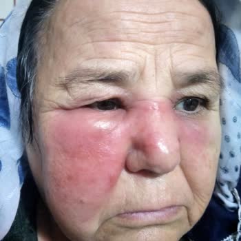 Cips Tüketimi Sonrası Ciddi Alerjik Reaksiyonlar