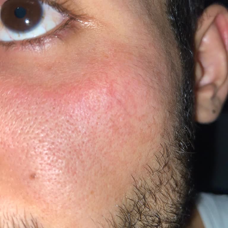 Claderm Kil Maskesi Deneyimim Hayal Kırıklığına Uğrattı