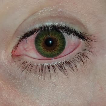 Air Optix Colors Lenslerinde Yırtılma Ve Kızarıklık Sorunu