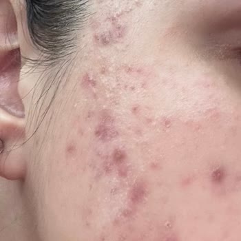 Yanlış Ürün Önerisi Cildimi Mahvetti