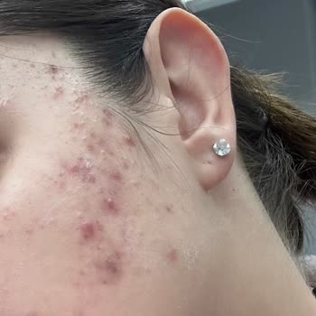 Yanlış Ürün Önerisi Cildimi Mahvetti