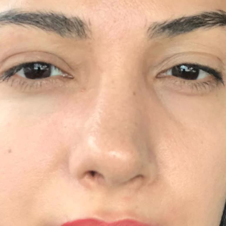 Burun Ameliyatı Sonrası Hayal Kırıklığı Ve Mağduriyet