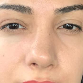 Burun Ameliyatı Sonrası Hayal Kırıklığı Ve Mağduriyet