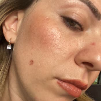 Güzellik Merkezinde Mağduriyet Ve Yanık Problemi