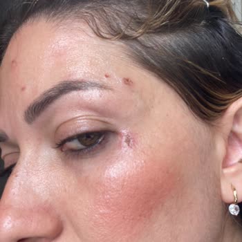 Güzellik Merkezinde Mağduriyet Ve Yanık Problemi