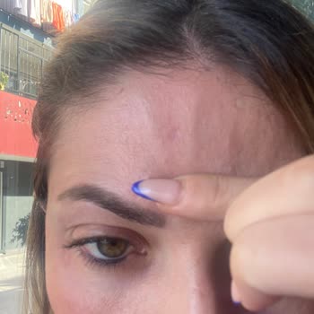 Güzellik Merkezinde Mağduriyet Ve Yanık Problemi