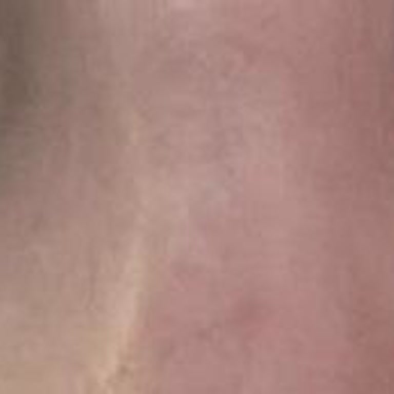 Fbm Tıp Merkezi Lipofilling Sonrası Beklenmedik Sorunlar