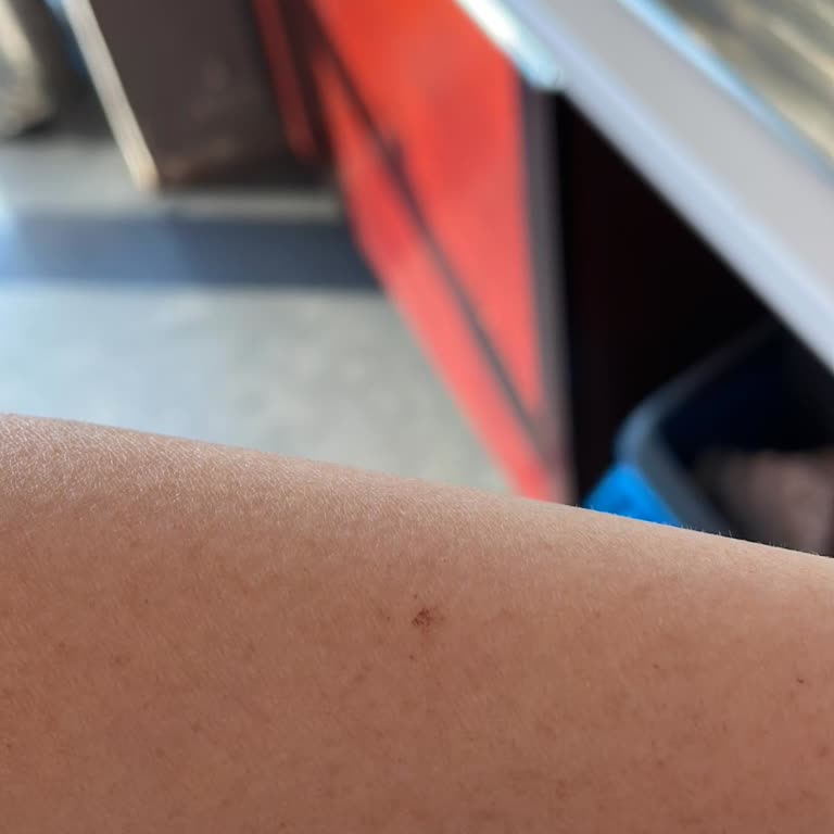 Sante Clinic Turkey Epilasyon Nedeniyle Vücudumun Çeşitli Yerlerinde Yanıklar Oluştu