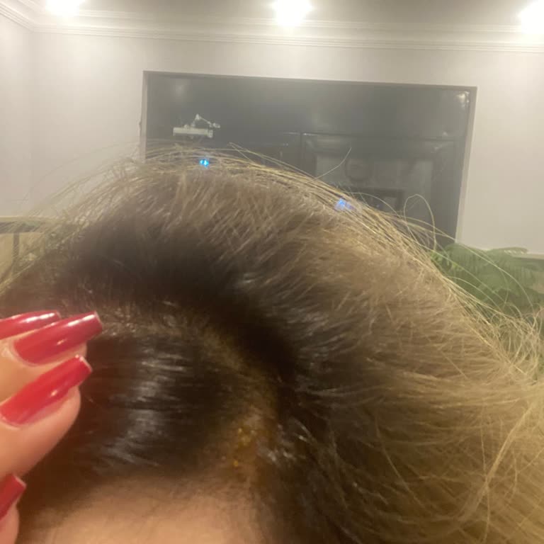 Kuaför Ziyareti Sonrası Saçlarım Yandı Ve Dökülüyor