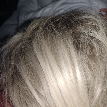 Saç Bakımı Faciası: Hayal Kırıklığı Ve Dökülen Saçlar