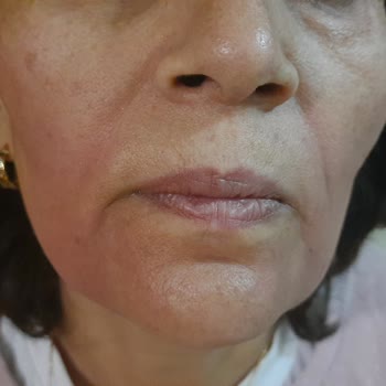 Loreal Revitalift Day Cream Caused Allergic Reaction, Store Refused Return