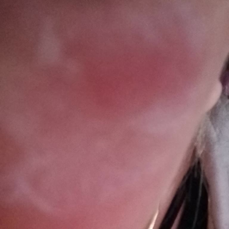 Ciltte Yanma Ve Kızarıklık Yapan Makyaj Temizleyici