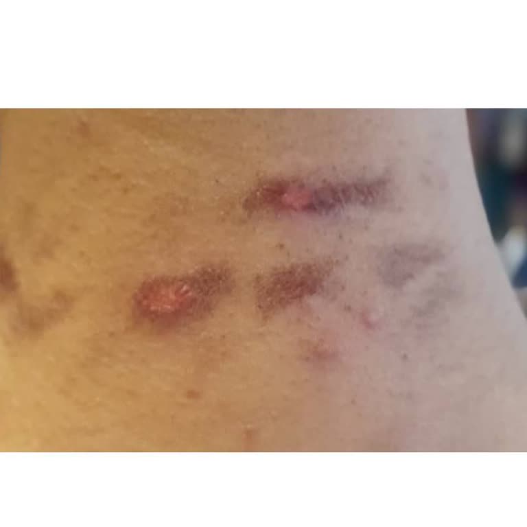 Epilasyon Hizmetinde Hayal Kırıklığı Ve Yanık Sorunu