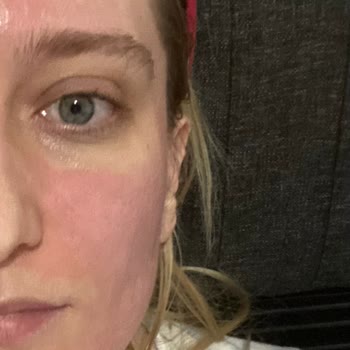 Pore Zero Serum Yüzümü Yaktı: Acil Çözüm Bekliyorum