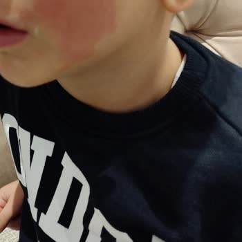 Mustela Kremi: Beklenmedik Yan Etkiler Ve Hayal Kırıklığı