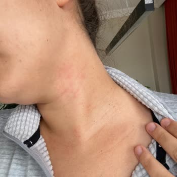 Yanlış Ürün Tavsiyesi Sonrası Ciltte Kızarıklık Ve Kaşıntı
