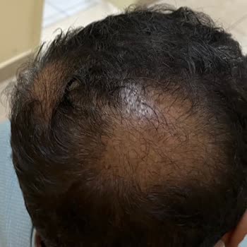 Estenivo Saç Ekimi Kliniği İle İlgili Hayal Kırıklığım Ve Rahatsız Edici Deneyimim!