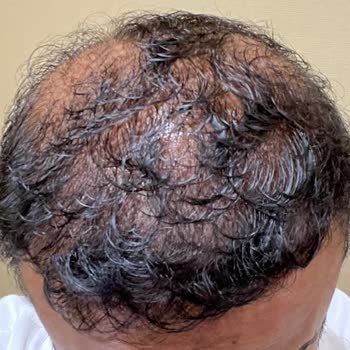 Estenivo Saç Ekimi Kliniği İle İlgili Hayal Kırıklığım Ve Rahatsız Edici Deneyimim!