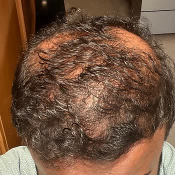 Estenivo Saç Ekimi Kliniği İle İlgili Hayal Kırıklığım Ve Rahatsız Edici Deneyimim!