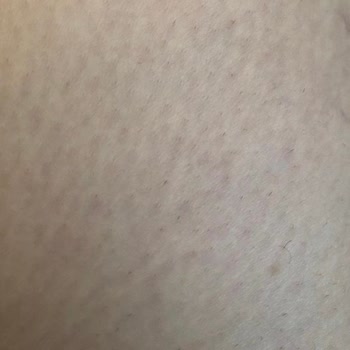 Meliderm Estetik Ve Güzellik Sincan Şube Beni Pişman Etti