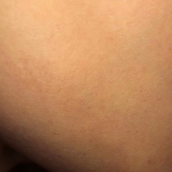 Meliderm Estetik Ve Güzellik Sincan Şube Beni Pişman Etti