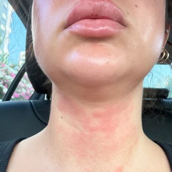 La Roche-Posay Lipikar Baume Caused Burning and Redness