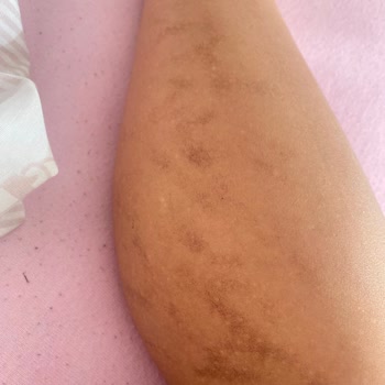 Ümraniye Estenova'da Yanık Ve Haksız Ücret Talebi