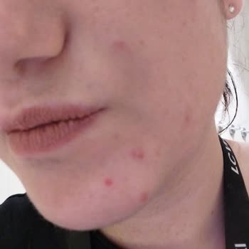 Güzellik Merkezinde Yapılan İşlem Sonrası Kalıcı İz Ve Yaralar