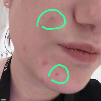 Güzellik Merkezinde Yapılan İşlem Sonrası Kalıcı İz Ve Yaralar