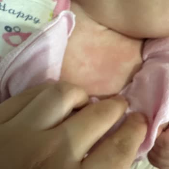 Bebek Yağında Beklenmedik Cilt Reaksiyonu