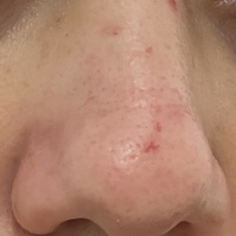 Cilt Bakımında Aşırı Baskı Sonrası Yaralar