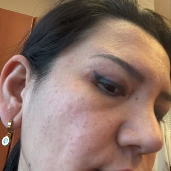 Bioderma Pigmentbio Ürününde Beklenmedik Alerji Sorunu