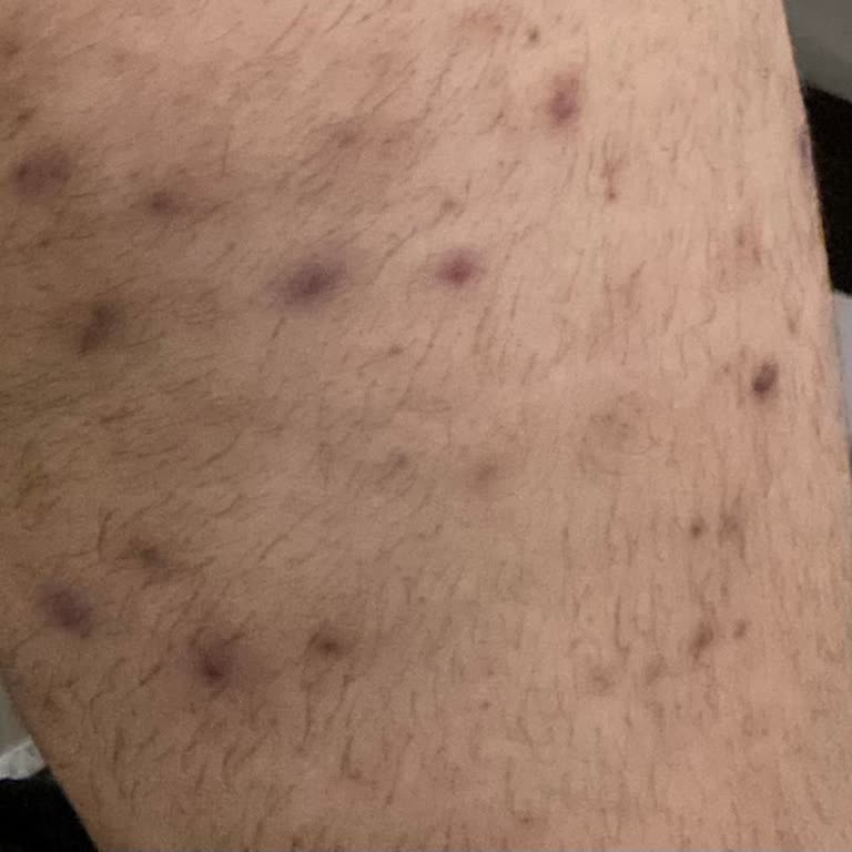 Veet Hair Removal Cream Caused Severe Allergic Reactions