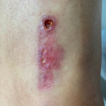 Prof. Dr. Zafer Kurumlu Bacağımı Mahvetti