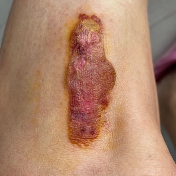 Prof. Dr. Zafer Kurumlu Bacağımı Mahvetti