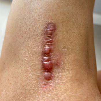 Prof. Dr. Zafer Kurumlu Bacağımı Mahvetti