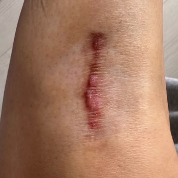 Prof. Dr. Zafer Kurumlu Bacağımı Mahvetti