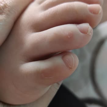 Skechers Yanlış Numara Ayakkabı Seçimi Sonrası Yaşanan Sorunlar