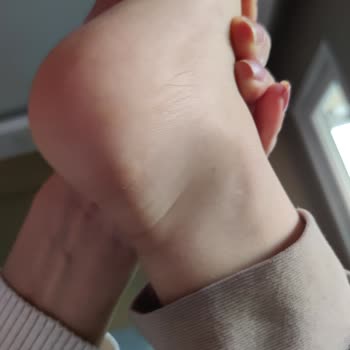 Skechers Yanlış Numara Ayakkabı Seçimi Sonrası Yaşanan Sorunlar