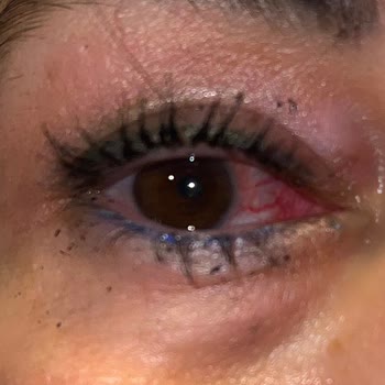 Lens Kullanımında Beklenmedik Sorunlar