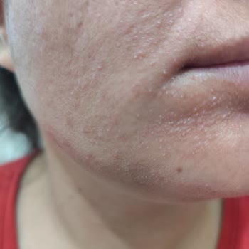 L'Oreal Revitalift Clinical Caused Severe Breakouts and Itching